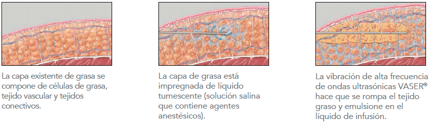 vaser-lipo-2