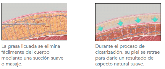 vaser-lipo-3