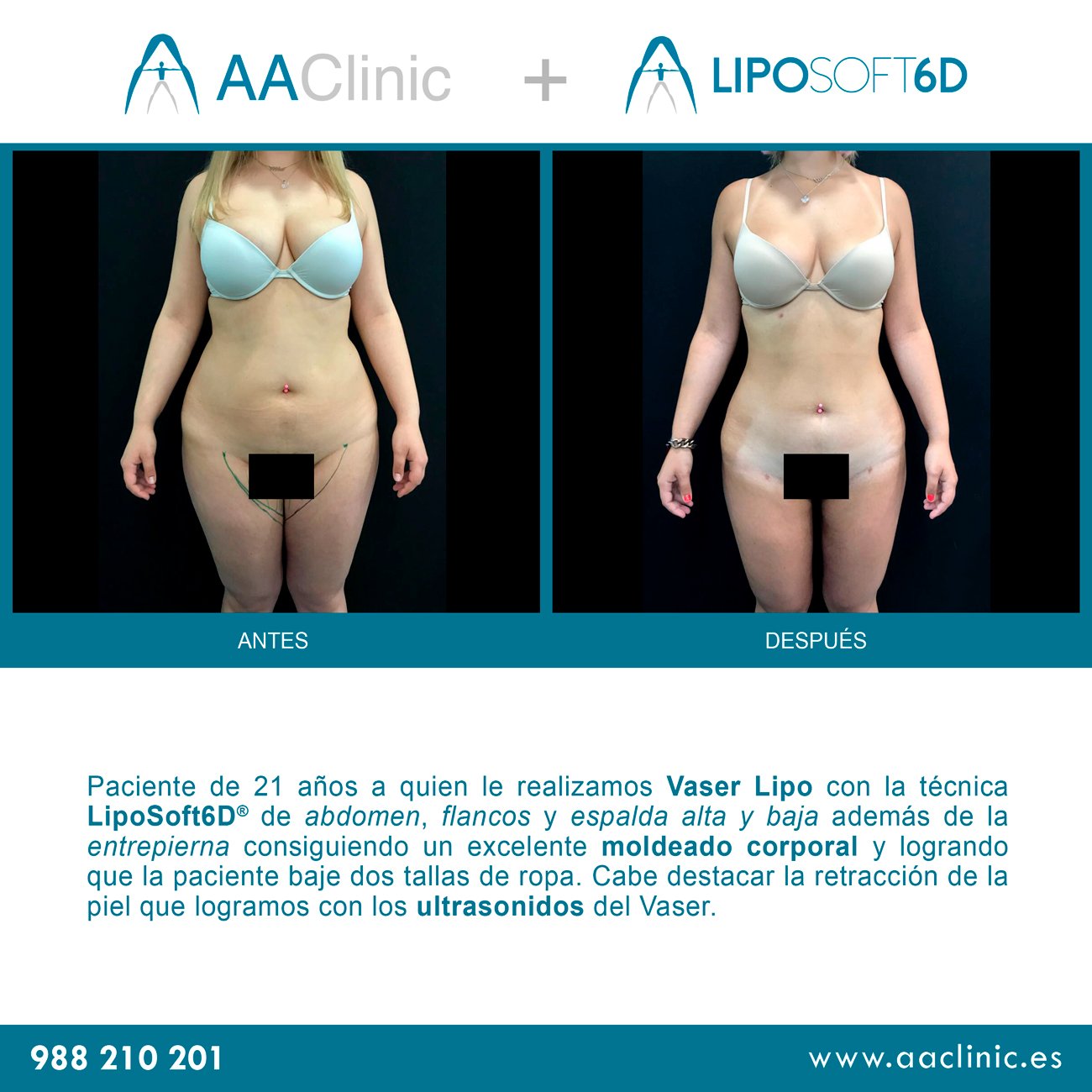 De y espalda abdomen lipo