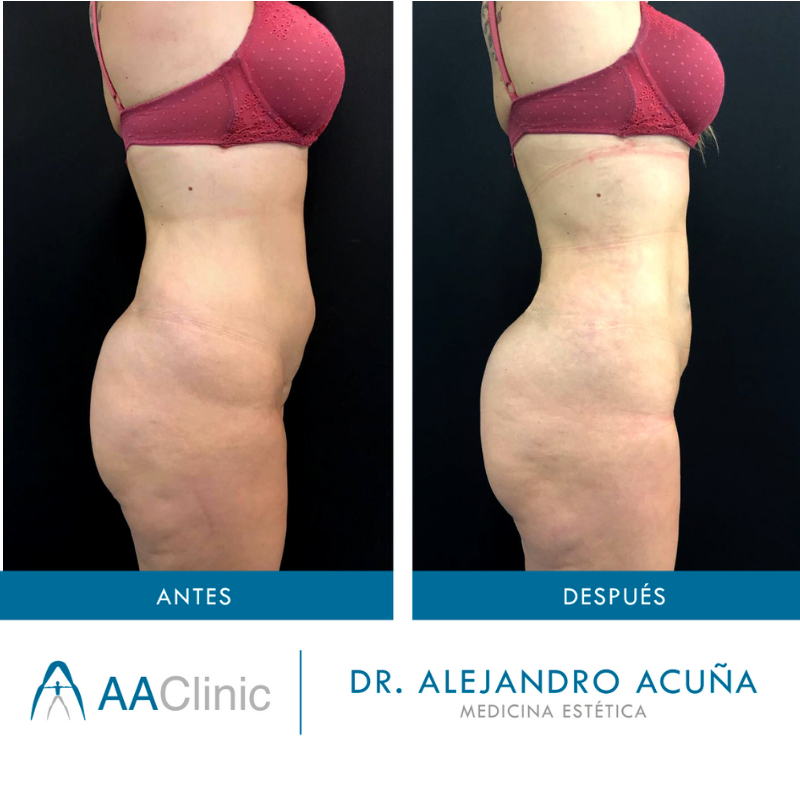 levantamiento de gluteos con radiofrecuencia antes y despues