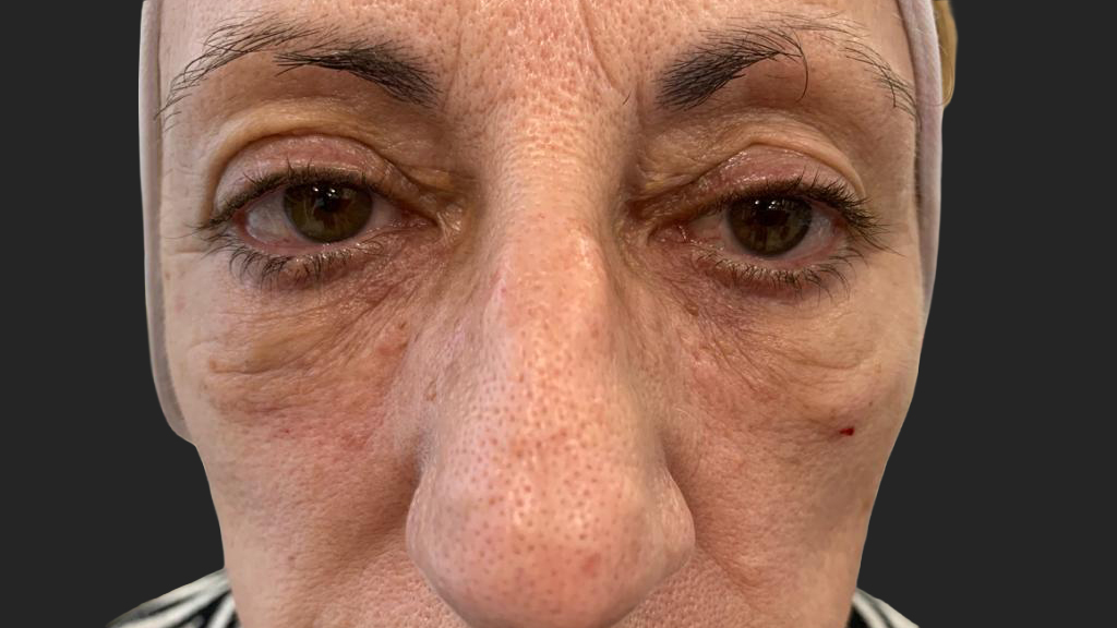 antes-y-despues-ojeras-alejandro-1