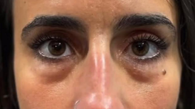 antes-y-despues-ojeras-alejandro-10