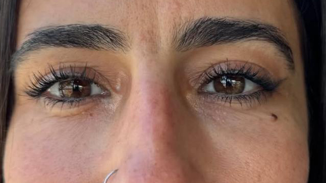 antes-y-despues-ojeras-alejandro-11