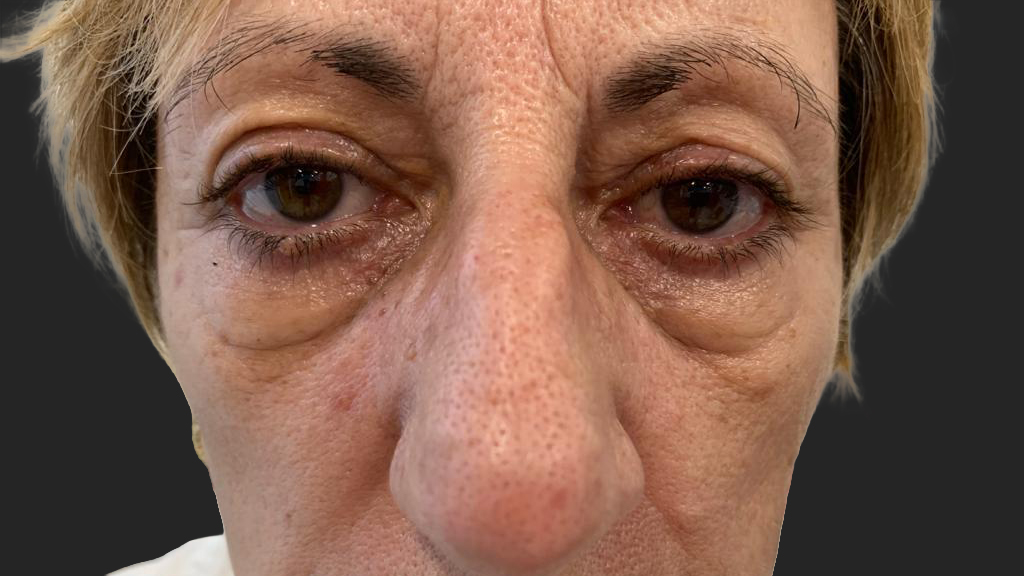 antes-y-despues-ojeras-alejandro-2