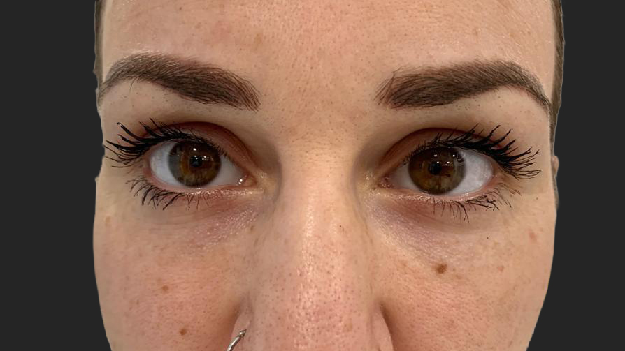 antes-y-despues-ojeras-alejandro-3