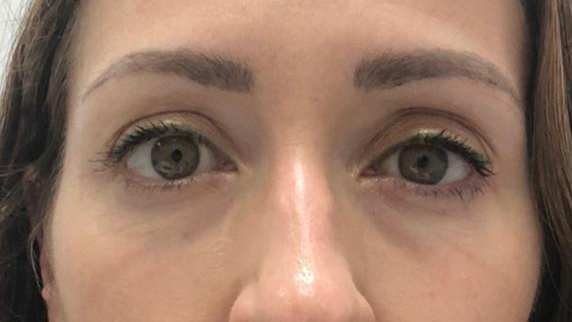 antes-y-despues-ojeras-alejandro-4