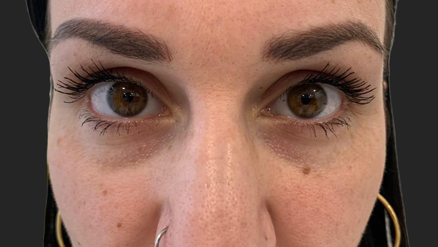 antes-y-despues-ojeras-alejandro-5