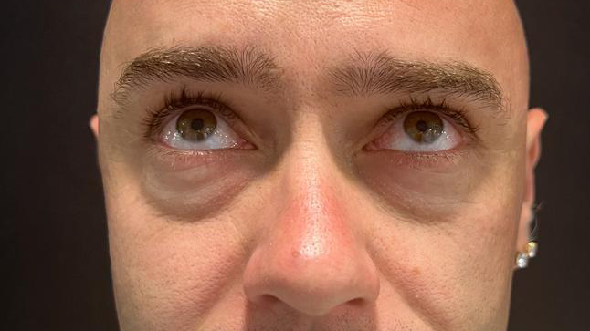 antes-y-despues-ojeras-alejandro-6