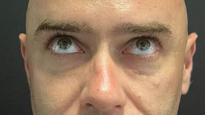 antes-y-despues-ojeras-alejandro-7