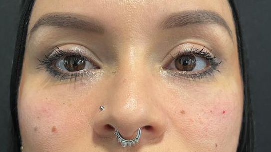 antes-y-despues-ojeras-alejandro-8