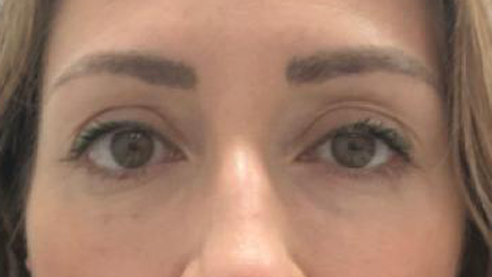 antes-y-despues-ojerasalejandro-4