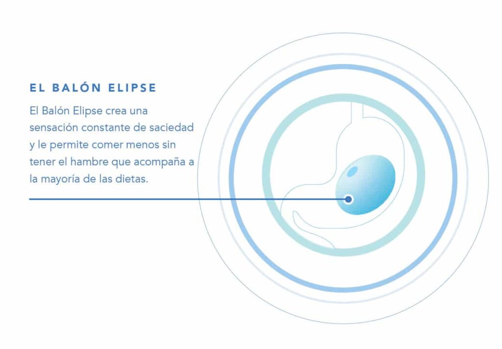 balon elipse by allurion - Dr. Alejandro Acuña