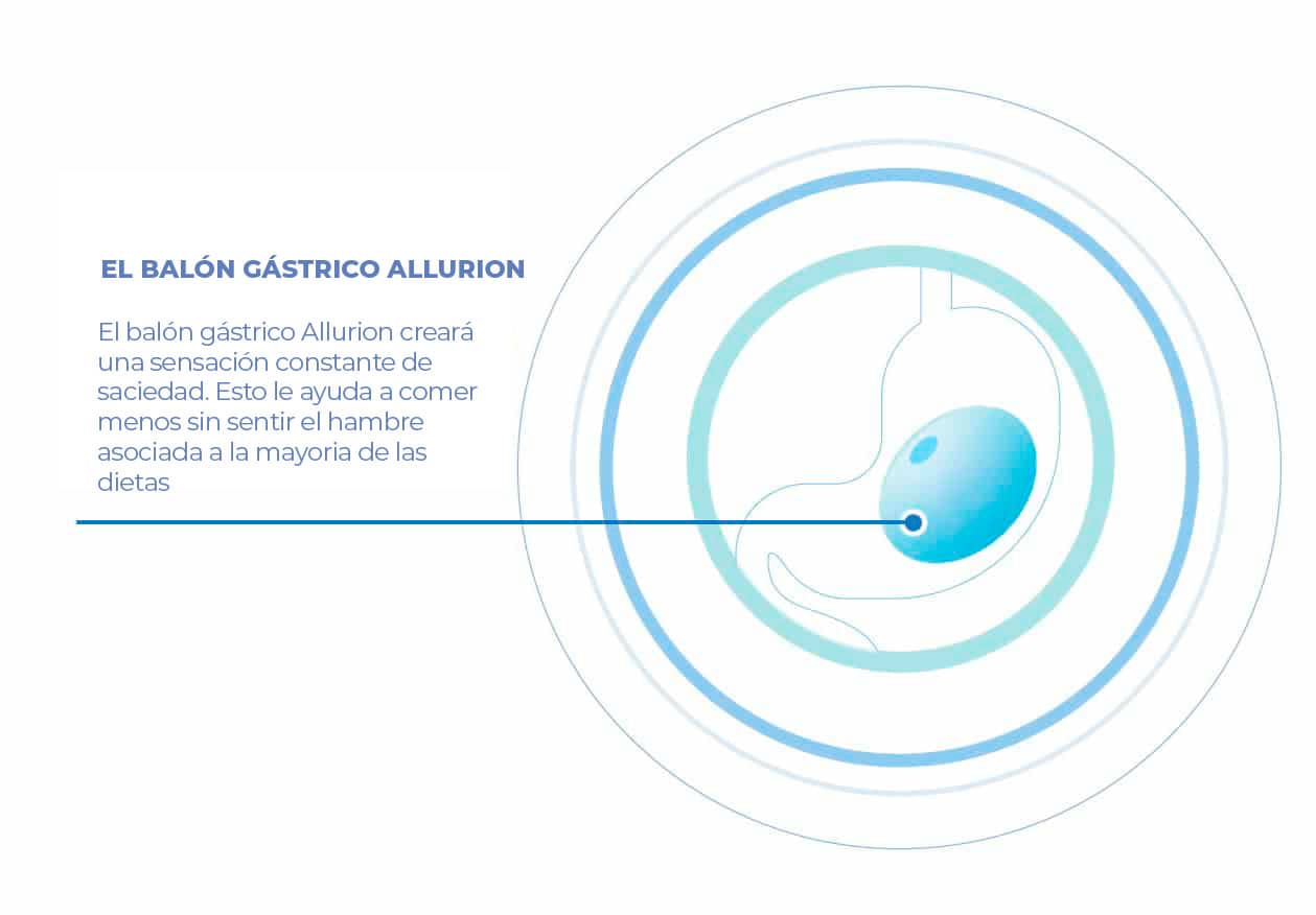 balon gastrico by allurion - Dr. Alejandro Acuña