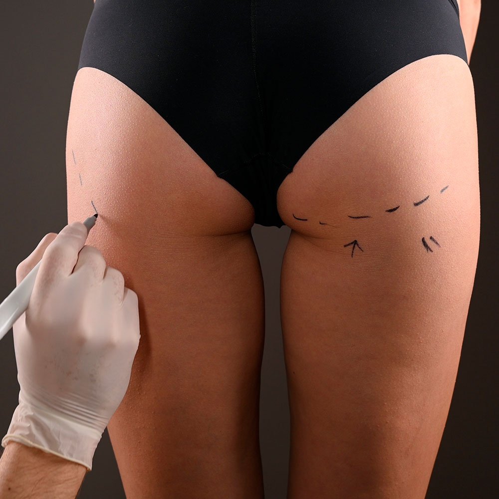 Vaser Lipo 7 - Dr. Alejandro Acuña dr alejandro vaser lipo preoperatorio - Dr. Alejandro Acuña