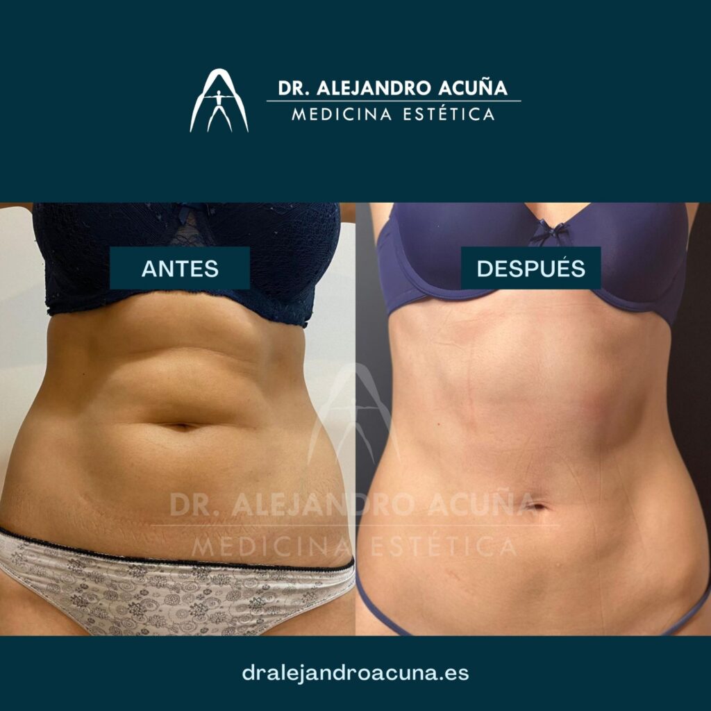 Antes y despues de Deep Slim