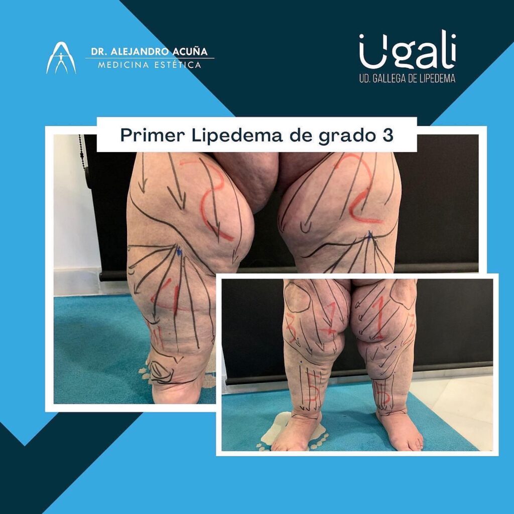 dr alejandro acuna piernas con lipedema - Dr. Alejandro Acuña