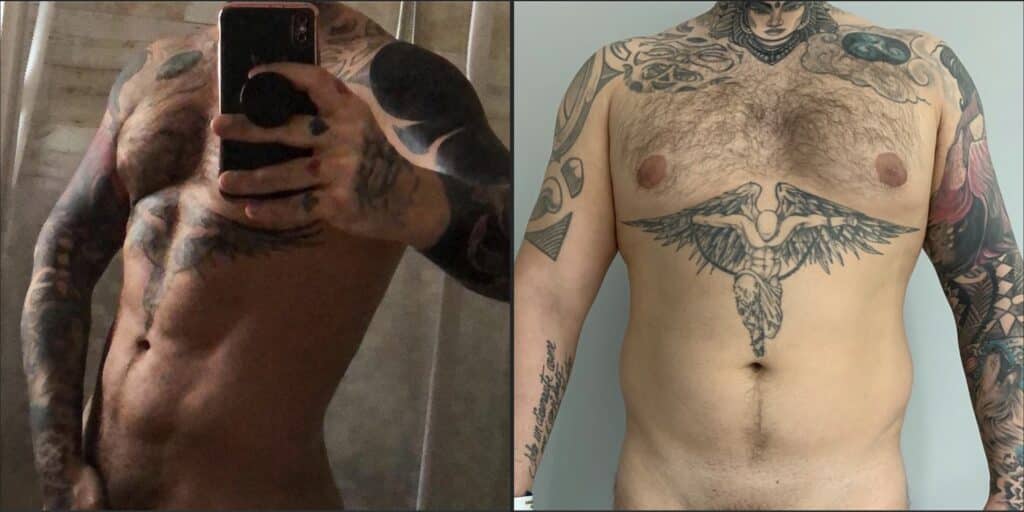 Vaser lipo para hombres antes y despues