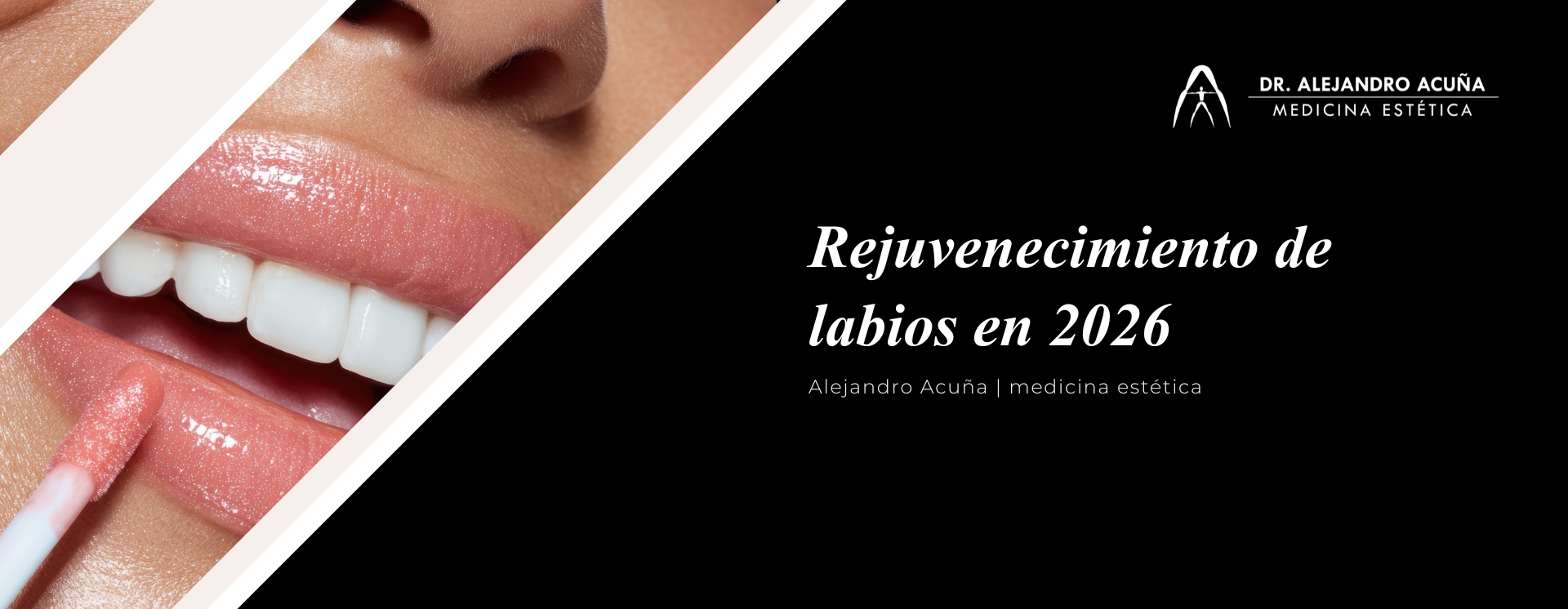 Rejuvenecimiento de labios en 2026: naturalidad y armonía facial