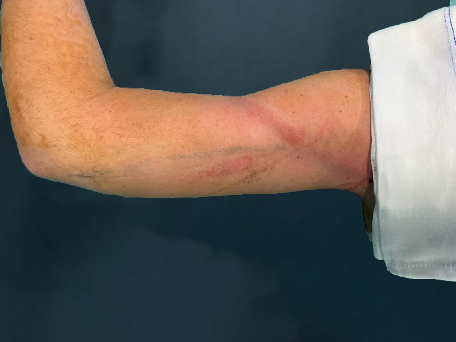 Endoláser 5 - Dr. Alejandro Acuña despues de endolaser en brazos