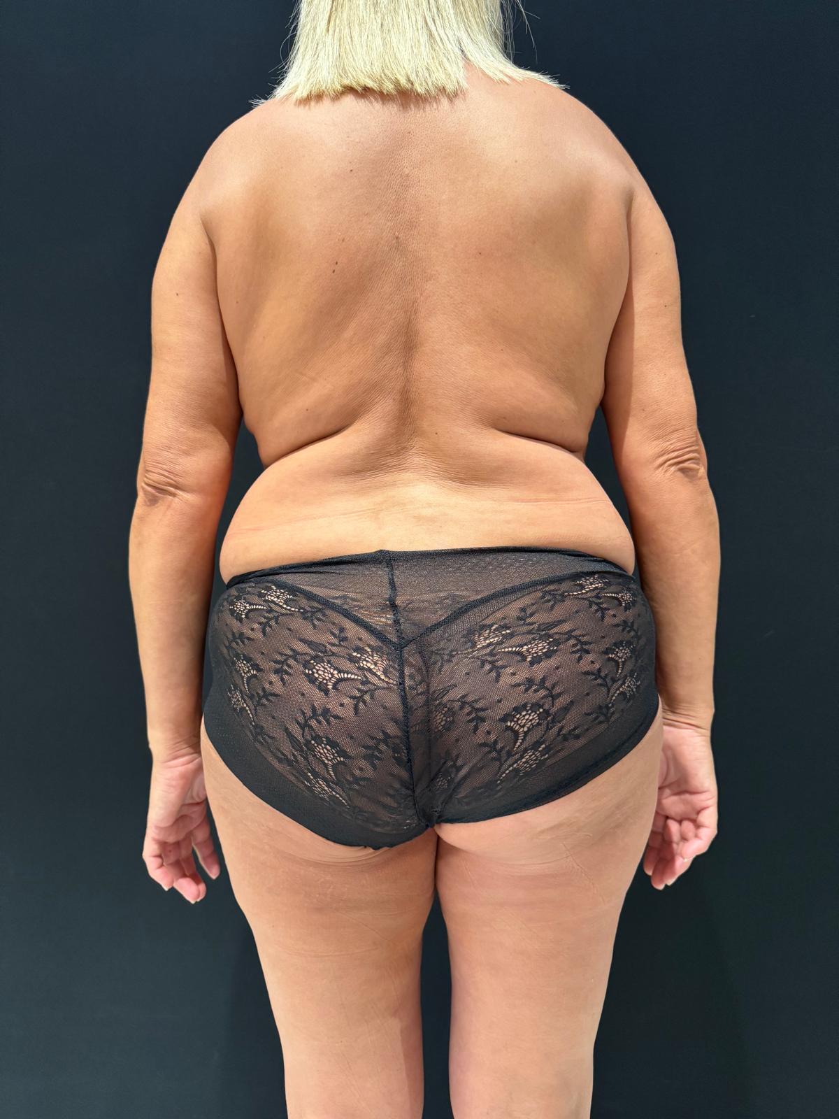 Endoláser 2 - Dr. Alejandro Acuña Antes de endolaser en flancos