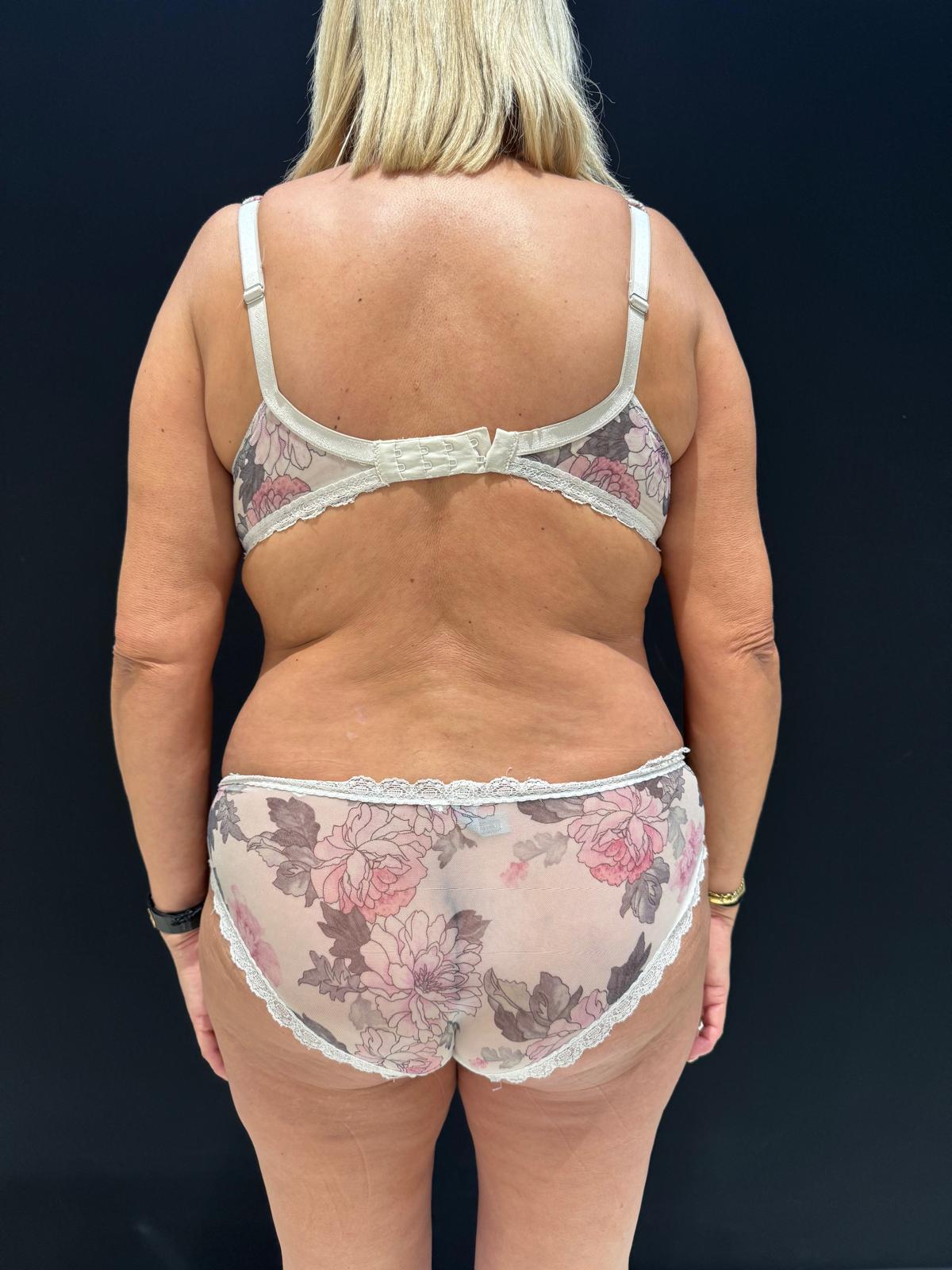 Endoláser 3 - Dr. Alejandro Acuña despues de endolaser en flancos