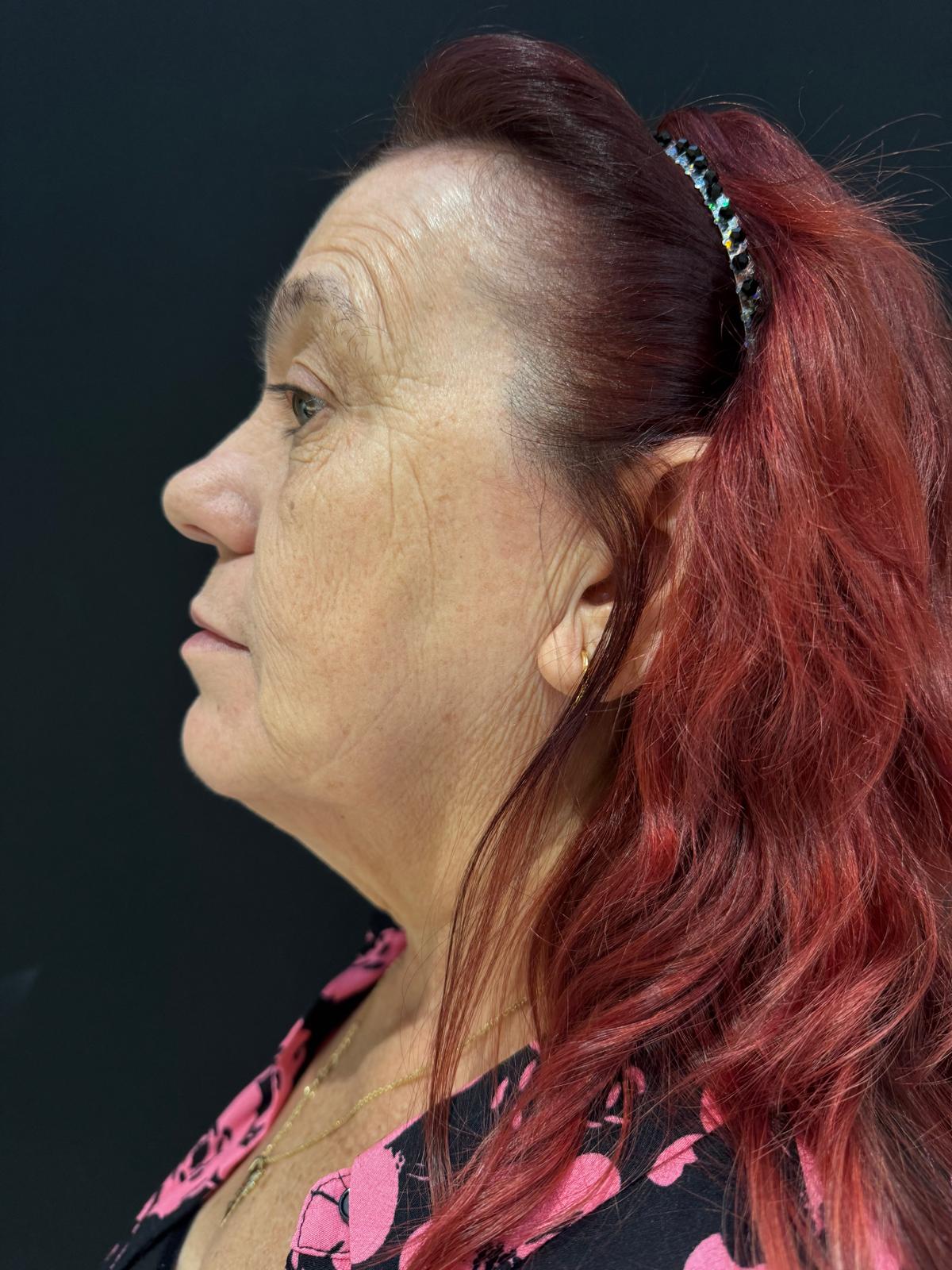 Endoláser 6 - Dr. Alejandro Acuña antes de endolaser en papada