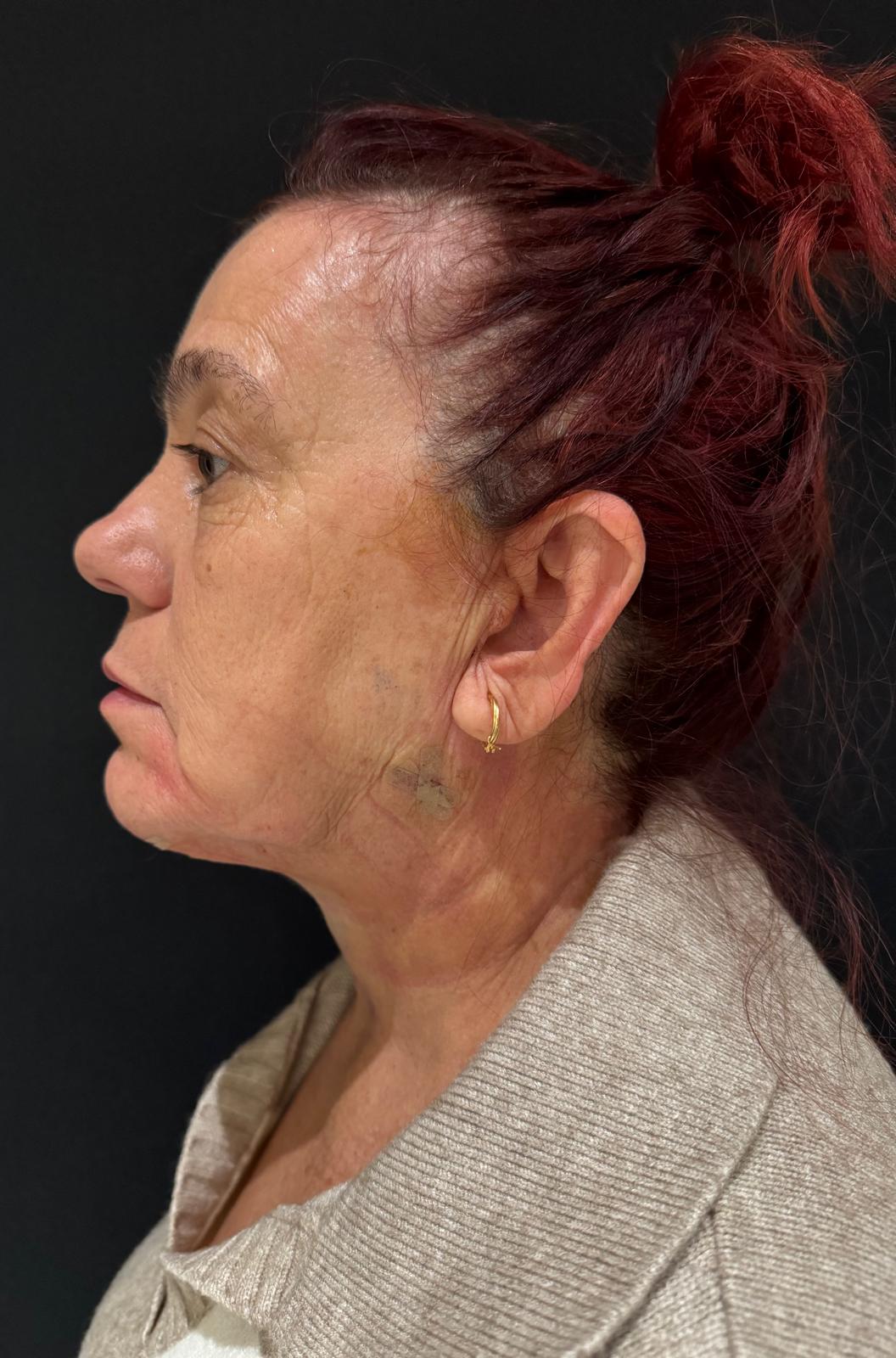 Endoláser 7 - Dr. Alejandro Acuña WhatsApp Image 2025-10-21 at 10.00.23