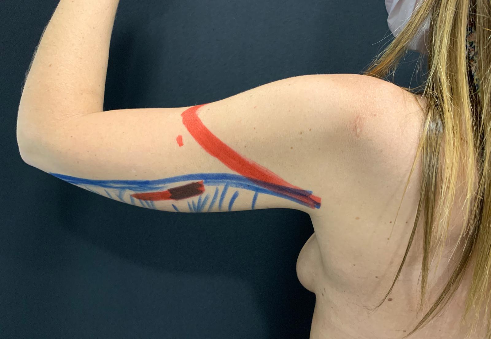 Endoláser 4 - Dr. Alejandro Acuña antes de endolaser en brazos