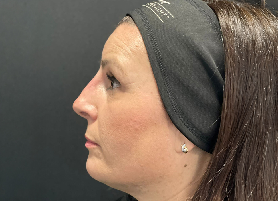 Antes-y-despues-alejandro-acuna-1