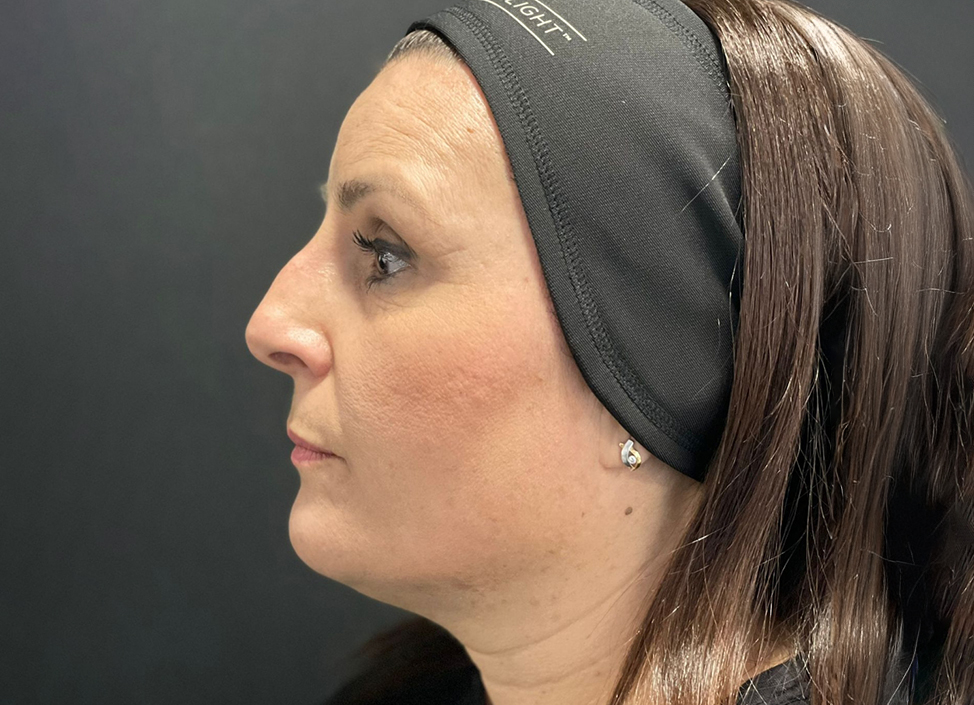 Antes-y-despues-alejandro-acuna-2