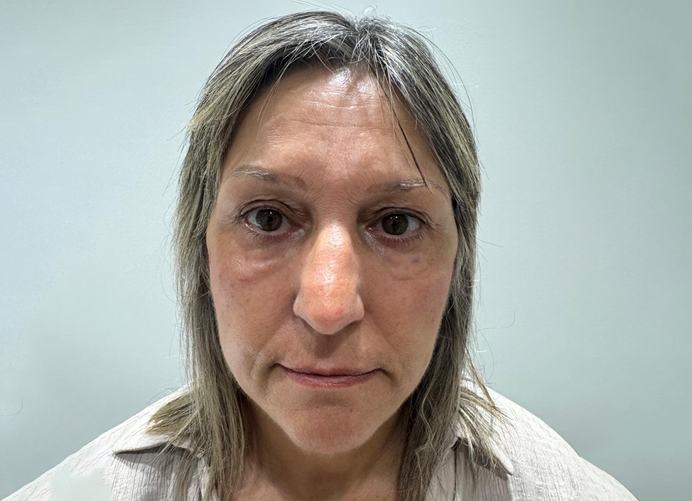 Antes-y-despues-alejandro-acuna-3