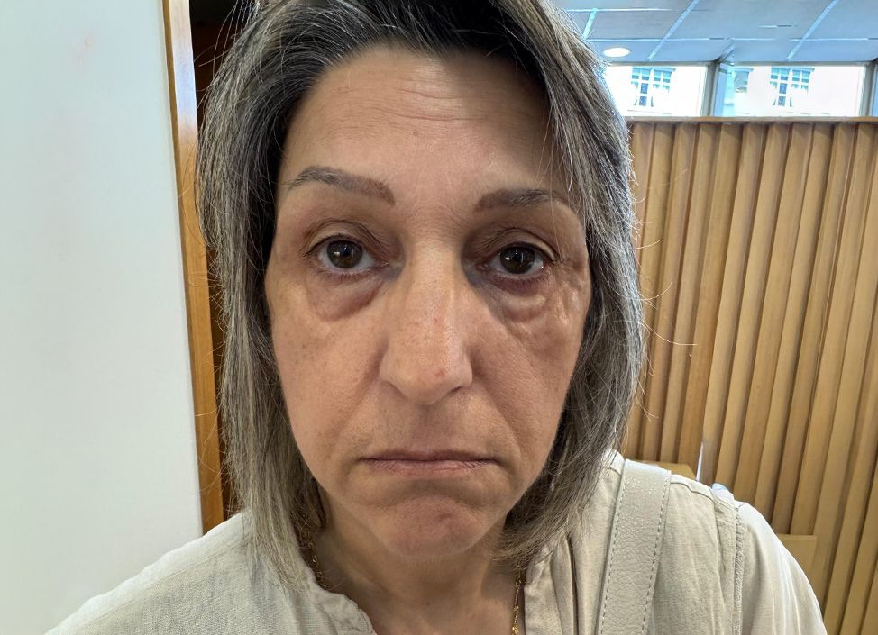 Antes-y-despues-alejandro-acuna-4