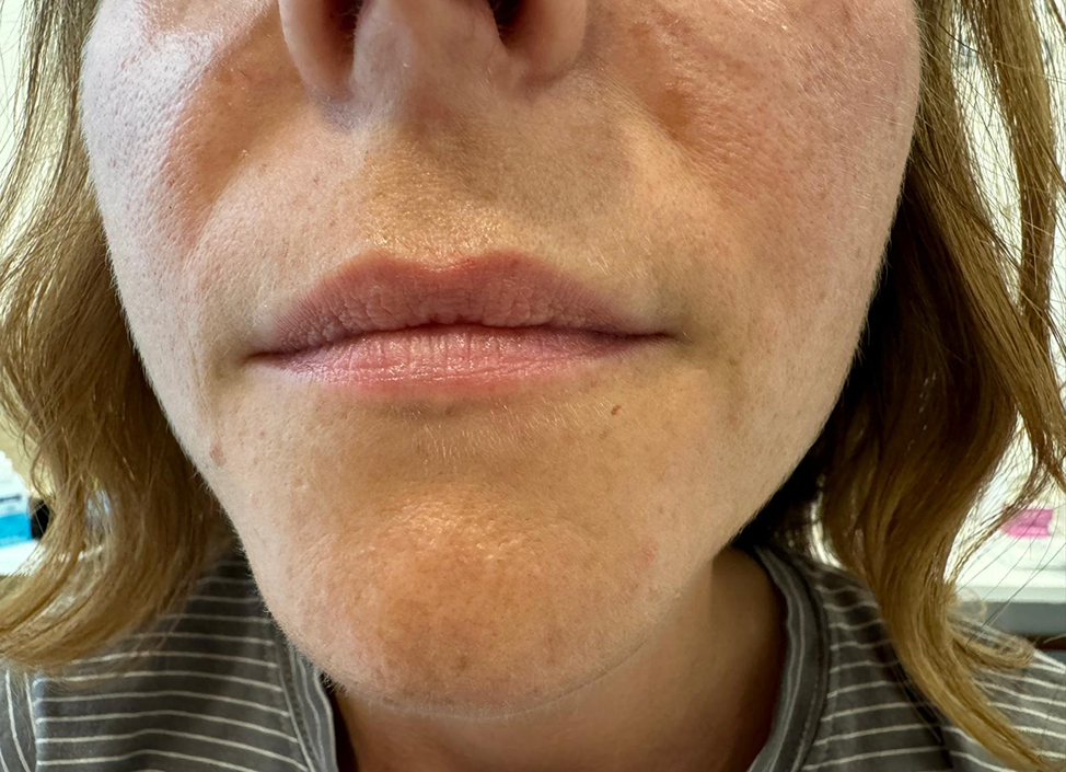 Antes-y-despues-alejandro-acuna-5