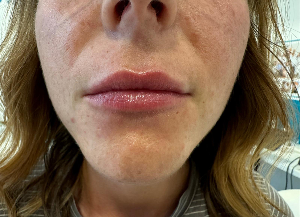 Antes-y-despues-alejandro-acuna-6