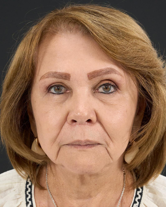 alejandro-acuna-antes-y-despues-full-face-1-sml