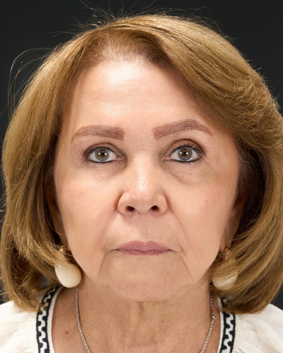 alejandro-acuna-antes-y-despues-full-face-2-sml