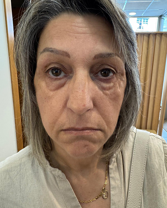 antes-y-despues-full-face-alejandro-2