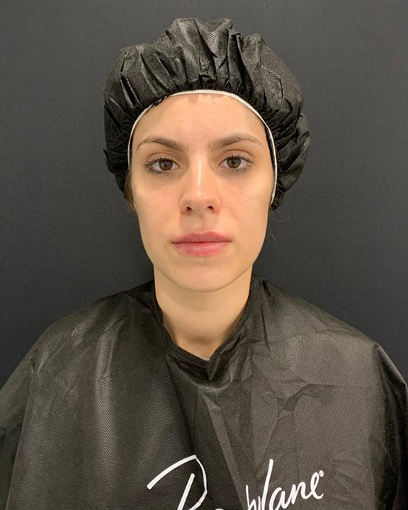 antes-y-despues-full-face-alejandro-3