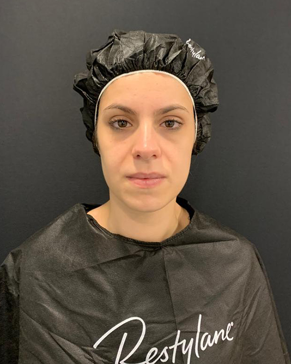 antes-y-despues-full-face-alejandro-4