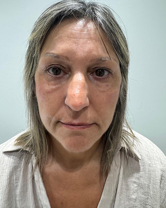 antes-y-despues-full-face-alejandro