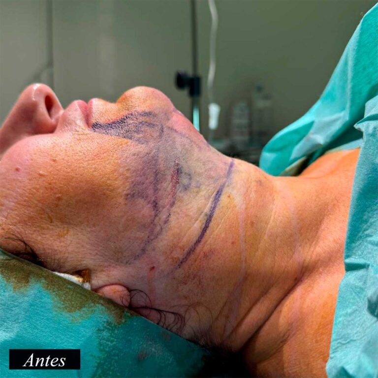 Antes de endolifting de papada