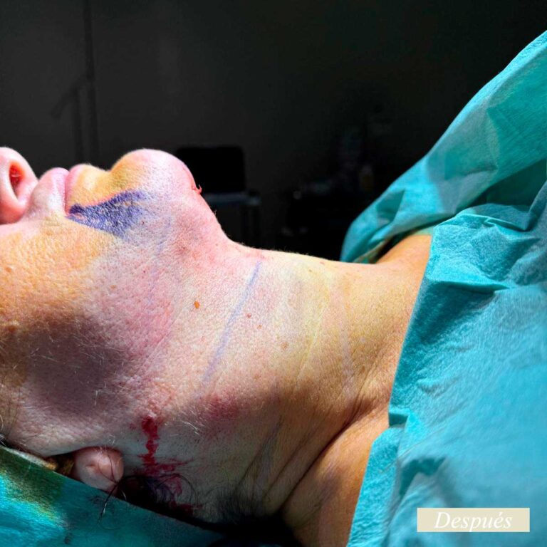 Despues de endolifting de papada