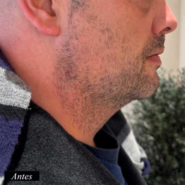 Antes de endolifting de papada