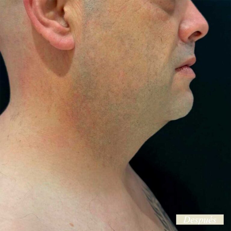 Despues de endolifting de papada