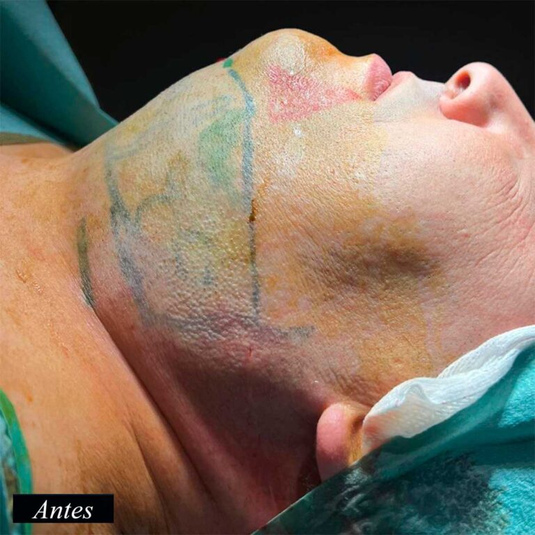 Antes de endolifting de papada