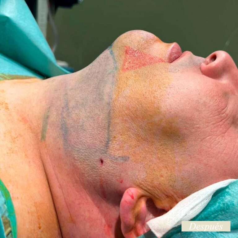 Despues de endolifting de papada