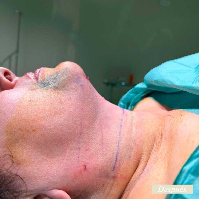 Despues de endolifting de papada