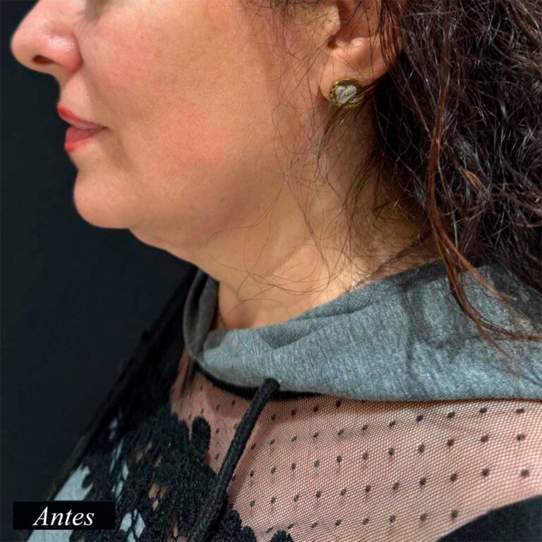 Antes de endolifting de papada