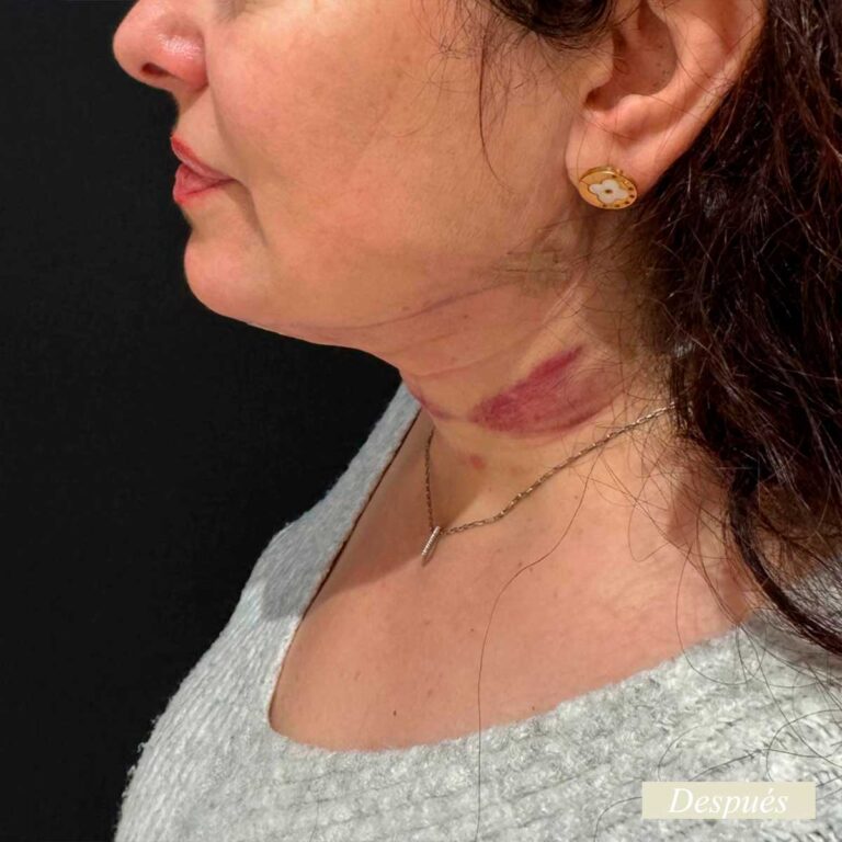 Despues de endolifting de papada