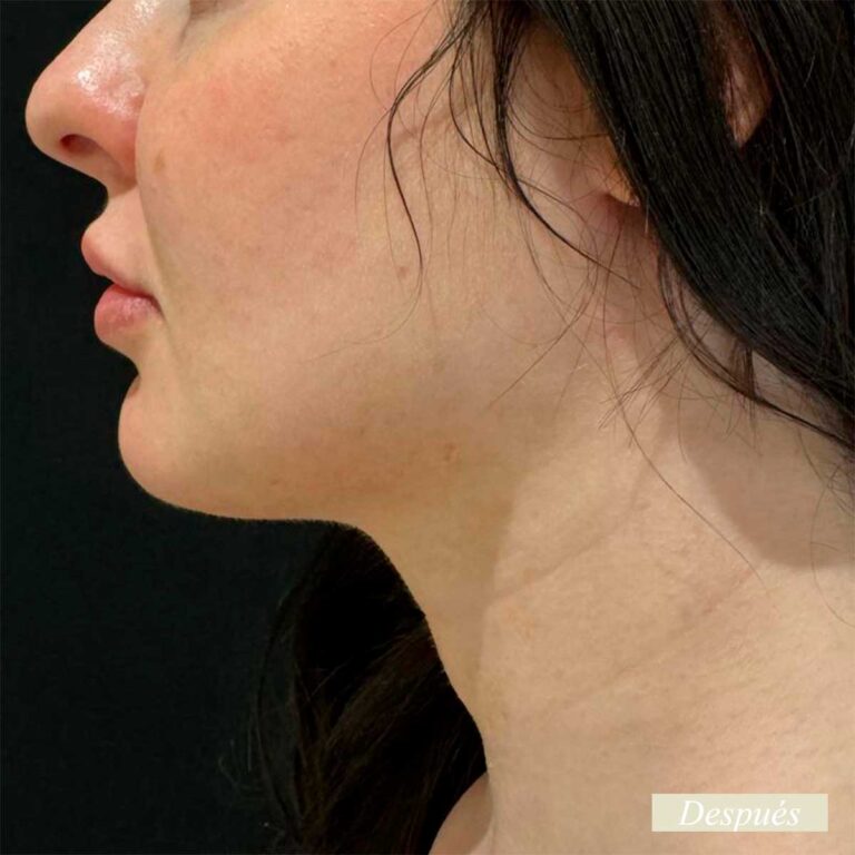 Desoues de endolifting de papada